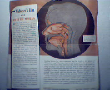 Auralgan in Treatment of Otits of Tonsils!